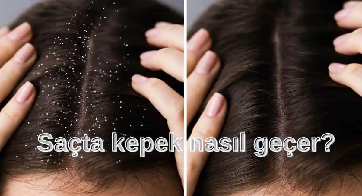 Kepek Nedenleri ve Tedavi Yöntemleri: Saç Sağlığını Koruma İpuçları