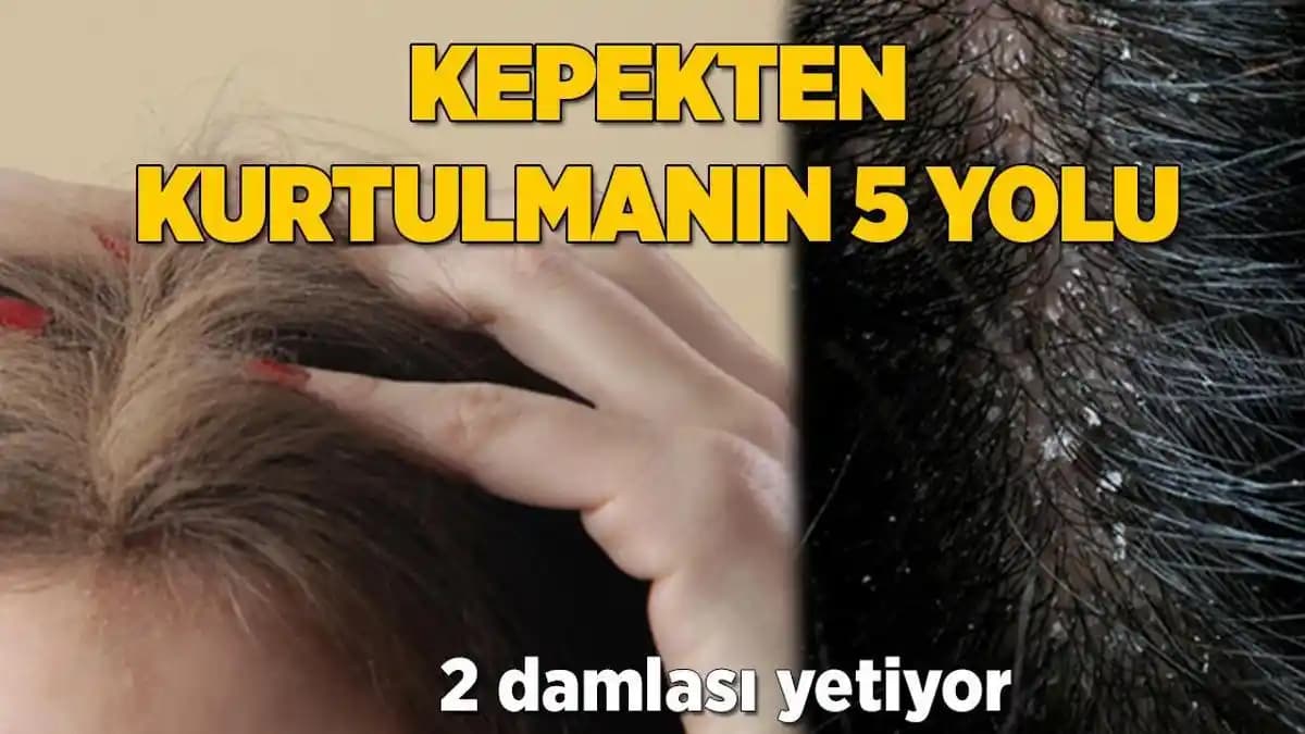 Kepekten Kurtulmanın Yolları: Saç Sağlığınızı Koruma ve Temizleme Rehberi