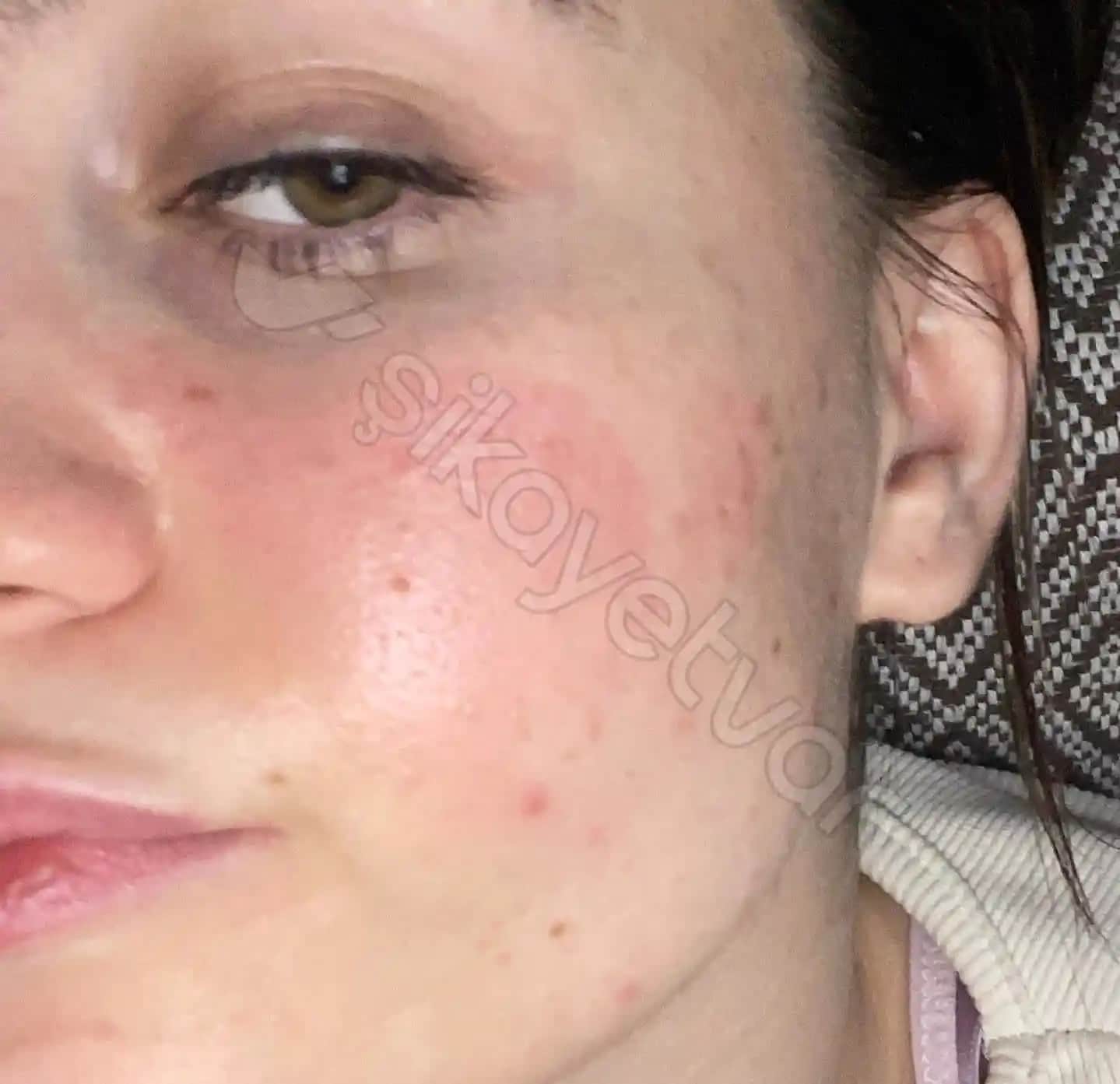 Kil Maskeleri Sonrası Kızarıklık Nedenleri ve Etkili Çözüm Yolları