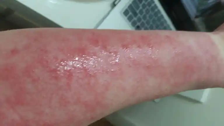 Kırmızı Cilt Lekeleri ve Kozmetik Yaklaşımlar: Nedenleri ve Etkili Çözümler