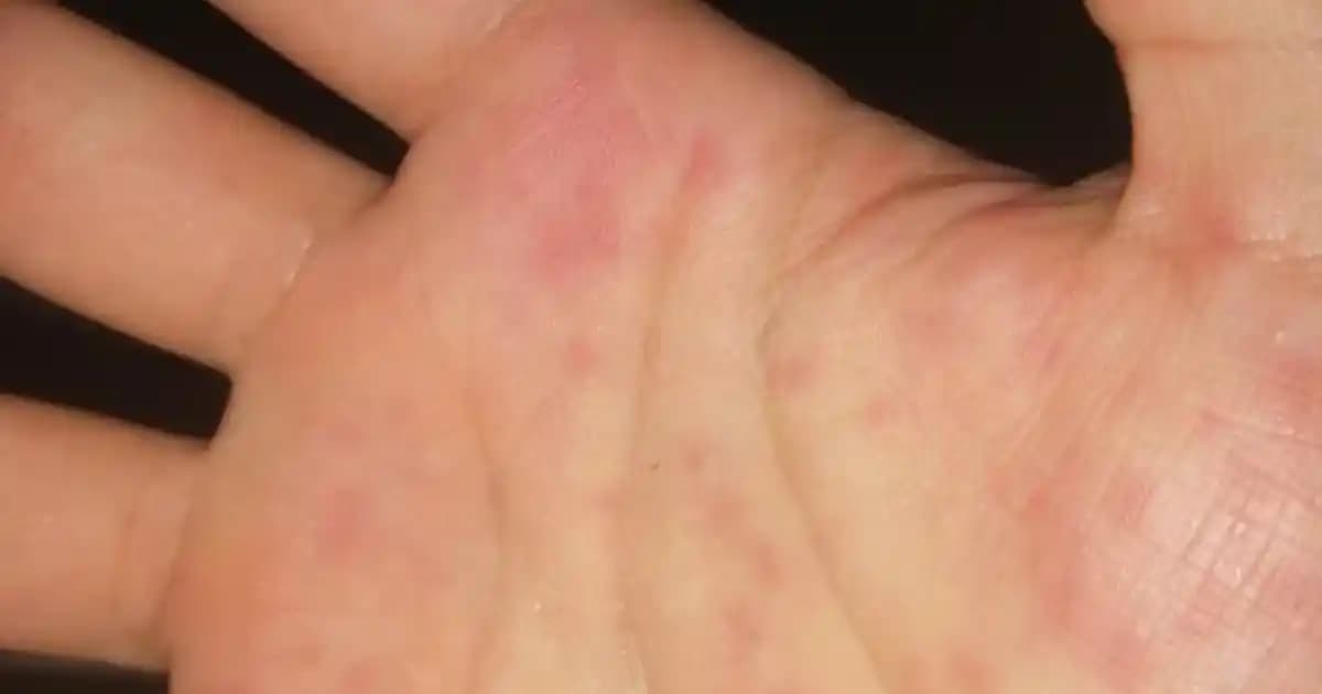 Kırmızı Nokta Problemi ve Kozmetik Yaklaşımlar: Sağlıklı Cilt İçin Bilmeniz Gerekenler