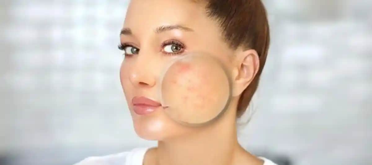 Kırmızı Sivilce İzleri Ne Zaman Geçer ve İyileşme Süreci Nasıl Hızlandırılır