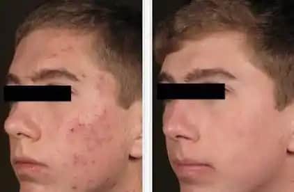 Kırmızı Sivilce İzleriyle Baş Etmenin Etkili Yolları ve Cilt Yenileme Rehberi