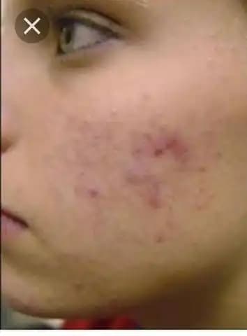 Kırmızı Sivilce Lekeleri ve Çözüm Yolları: Cilt Sağlığını Koruma Rehberi