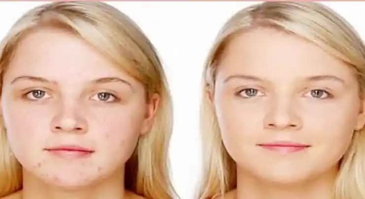 Kistik Akne Nasıl Geçer? Etkili Tedavi ve Bakım Yöntemleri