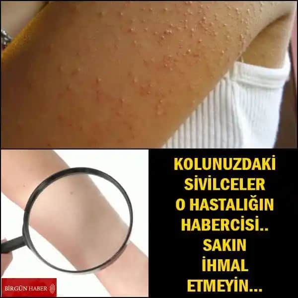 Kol Arkası Sivilce Nedenleri, Önlenmesi ve Etkili Bakım Yöntemleri Rehberi