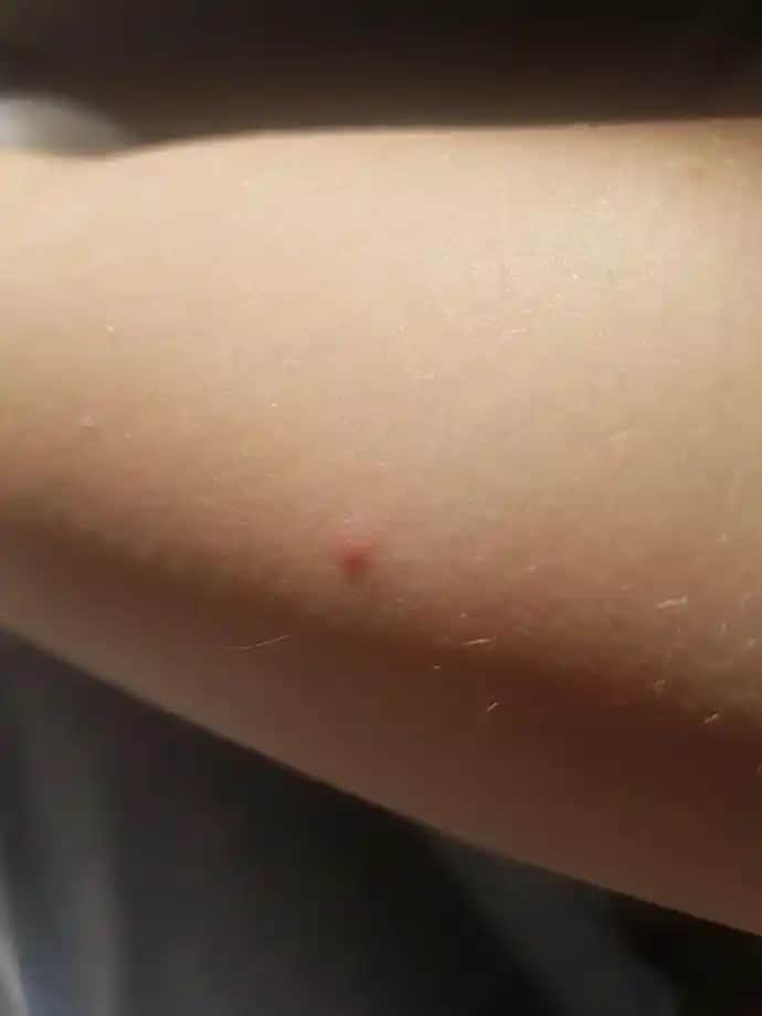 Kolda Aniden Çıkan Kızarıklıkların Nedenleri ve Cilt Sağlığına Etkileri