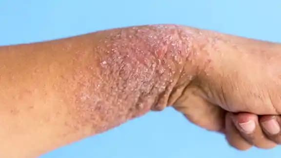 Kolda Egzama Belirtileri, Tanı ve Etkili Koruma Yöntemleri Hakkında Güncel Bilgiler