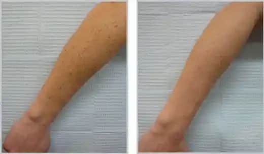 Kolda Güneş Lekeleri Nasıl Geçer: Nedenleri ve Etkili Tedavi Yöntemleri