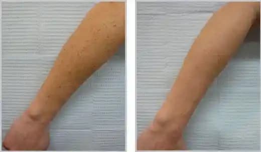 Kolda Güneş Lekeleri Nasıl Geçer: Nedenleri ve Etkili Tedavi Yöntemleri