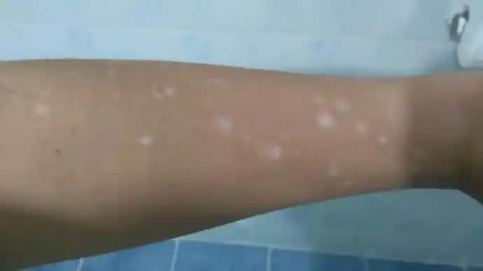 Kolda Leke Nedenleri ve Etkili Tedavi Yöntemleri Hakkında Detaylı Bilgi