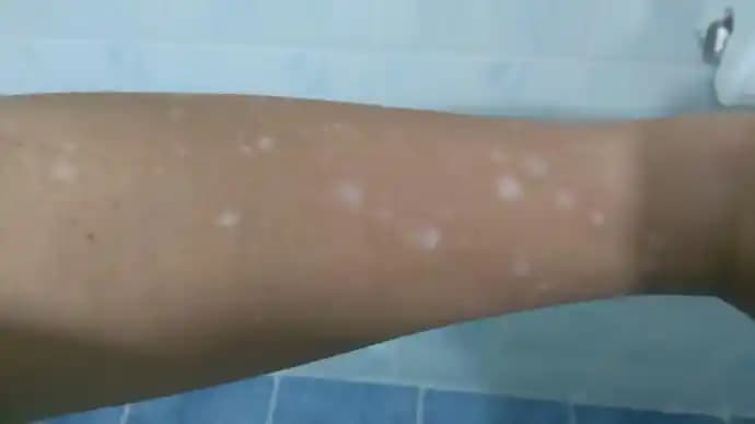 Kolda Leke Nedenleri ve Etkili Tedavi Yöntemleri Hakkında Detaylı Bilgi