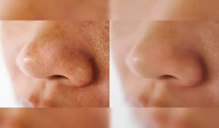 Kolda Siyah Noktalar ve Çözüm Yolları: Cilt Sağlığınızı Korumanın Etkili Yöntemleri