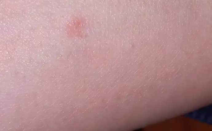 Kolda Yeşil Lekeler ve Kozmetik Yaklaşımlar: Nedenleri ve Tedavi Yöntemleri