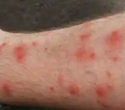 Koldaki Lekelerin Nedenleri ve Etkili Tedavi Yöntemleri Hakkında Kapsamlı Bilgi