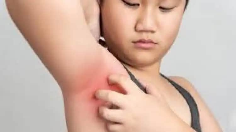 Koltuk Altı Kızarıklığı ve Krem Kullanımı: Güvenli ve Etkili Çözüm Yöntemleri