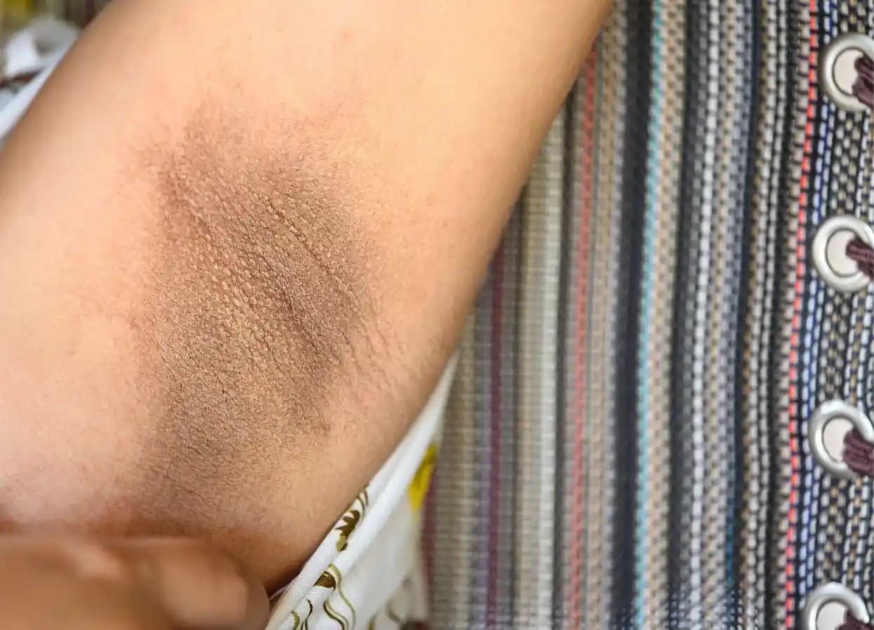 Koltuk Altı Sararması Nedenleri ve Etkili Çözüm Yöntemleri Hakkında Bilmeniz Gerekenler