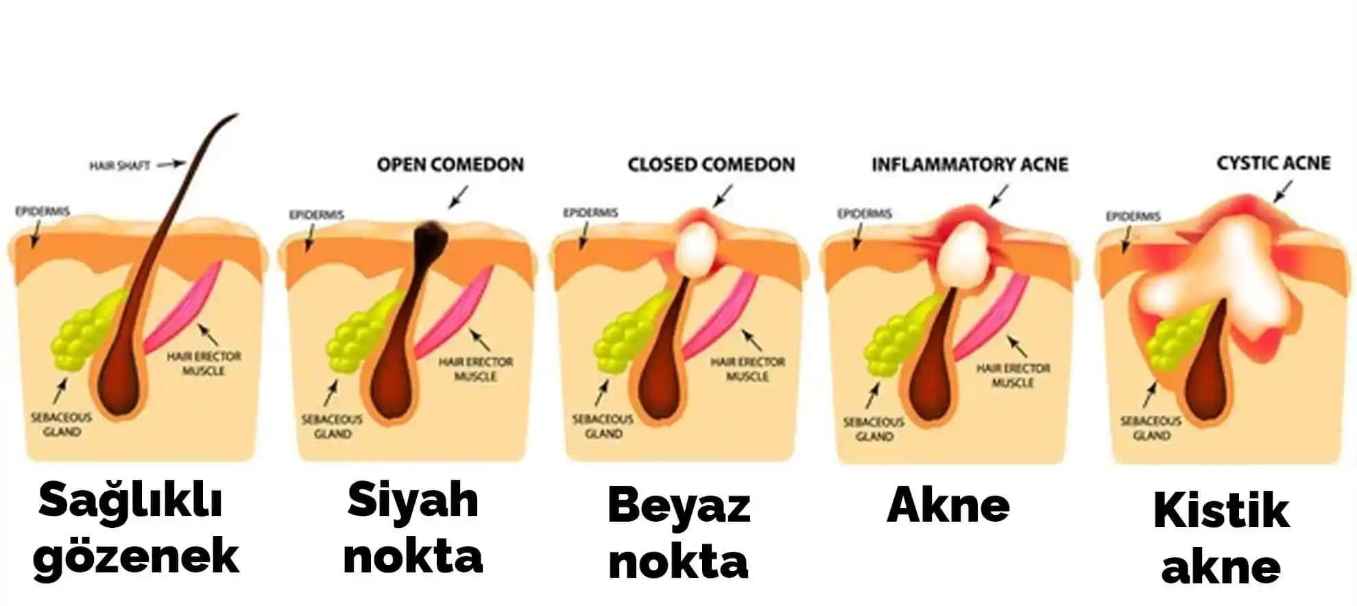 Komedonlara Karşı Etkili Cilt Bakımı Yöntemleri ve Kozmetik Ürün Seçimi