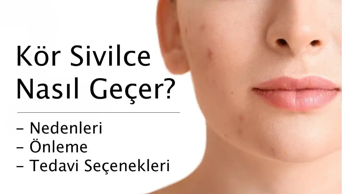 Kör Sivilceler Nasıl Geçer Cilt Sağlığını Koruma Yöntemleri ve İpuçları