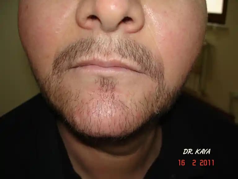 Köse Sakal Nasıl Çıkar? Doğal Yollar ve Bakım İpuçlarıyla Sakal Gelişimini Destekleyin