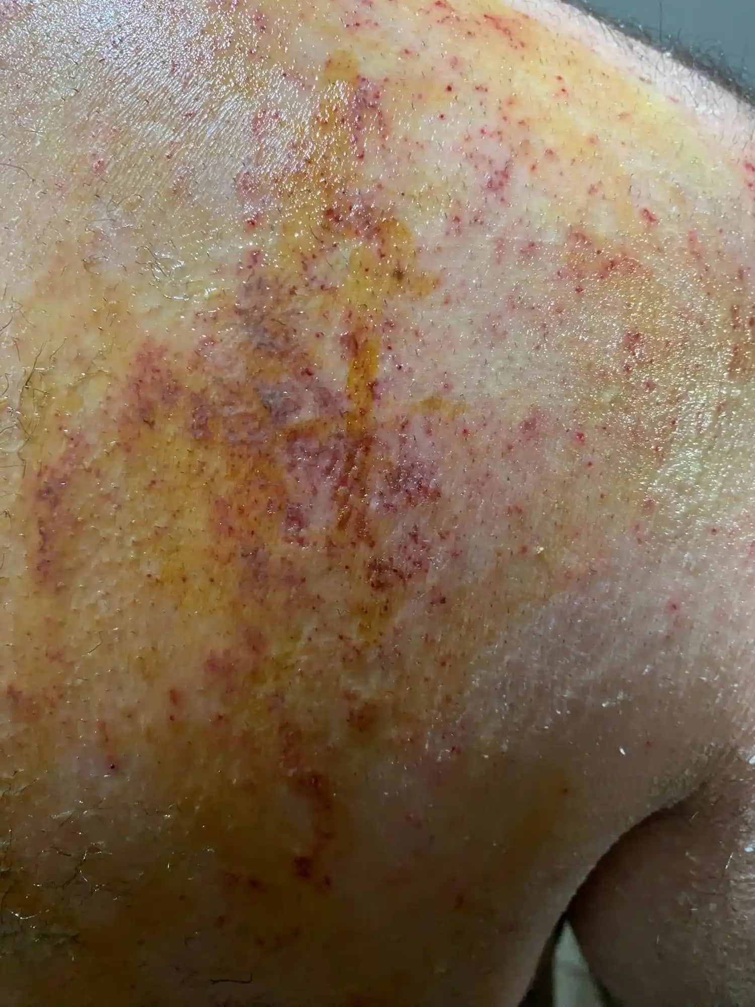 Kozmetik Alanında Deri Tahrişi Nedenleri, Belirtileri ve Çözüm Yolları