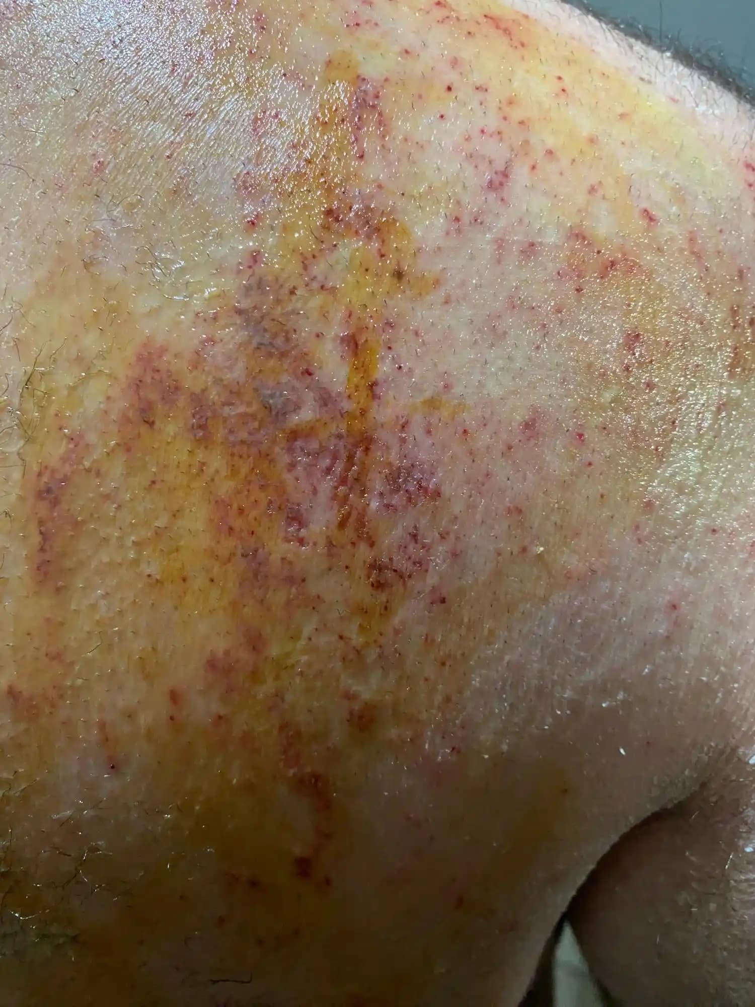 Kozmetik Alanında Deri Tahrişi Nedenleri, Belirtileri ve Çözüm Yolları