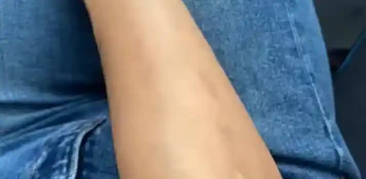 Kozmetik ve Bakımda Kol Yanığına Karşı Doğru Uygulama ve Koruma Yöntemleri