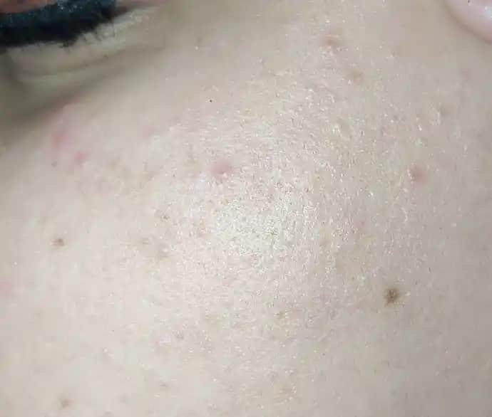 Küçük Sivilcelerle Mücadele ve Sağlıklı Cilt İçin Uygun Bakım Yöntemleri