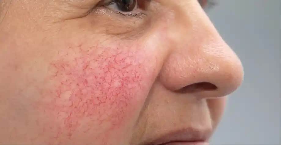 Kuperoz Nedir, Belirtileri ve Cilt Bakımında Uygulanabilecek Etkili Yöntemler