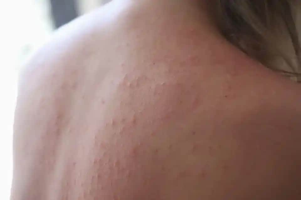 Kuru Cilt ve Kaşıntıyı Kontrol Altına Almanın Etkili Yolları