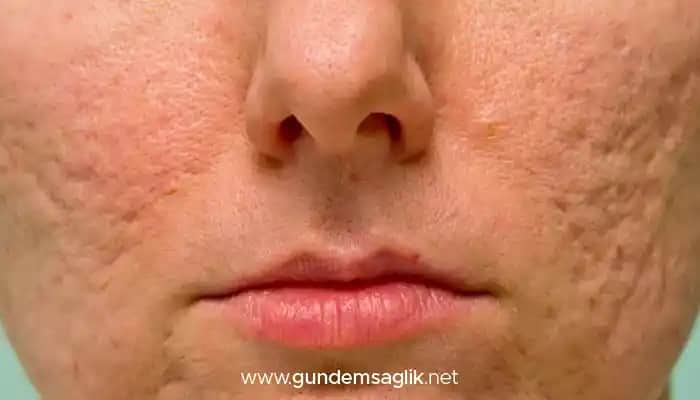 Kuru Ciltte Sivilce Lekeleri Nasıl Geçer ve Etkili Bakım Yöntemleri