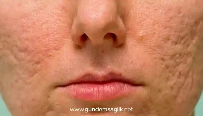 Kuru Ciltte Sivilce Lekeleri Nasıl Geçer ve Etkili Bakım Yöntemleri