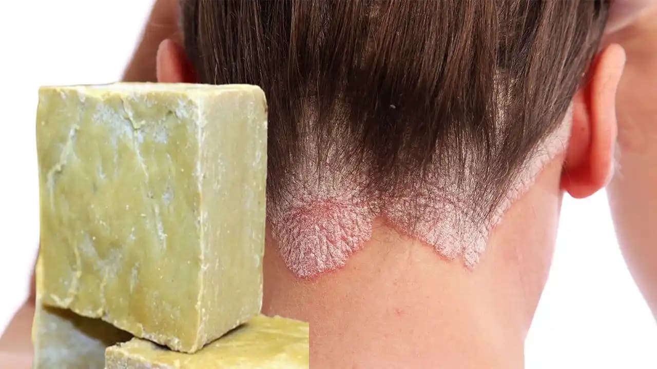 Kuruluk Egzaması Nedir, Belirtileri, Nedenleri ve Tedavi Yöntemleri Hakkında Detaylı Bilgi