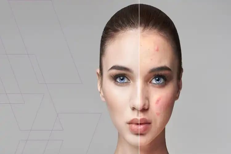 Lazerle Yüz Bakımı ve Sivilce Riski: Güvenli Uygulamalar ve Doğru Bilinen Yanlışlar