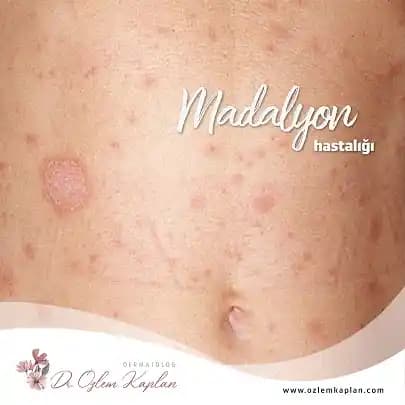 Madalyon Hastalığı Nedir, Belirtileri ve Kozmetik Çözümlerle Tedavi Yöntemleri