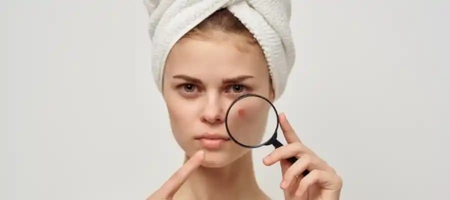 Mantar Akne Belirtileri, Tanı ve Etkili Tedavi Yöntemleri Hakkında Kapsamlı Bilgi
