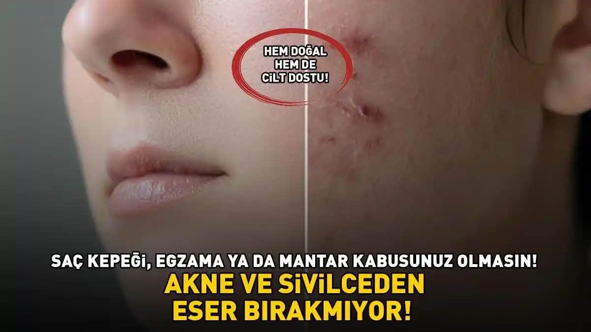 Mantar Akne Nedir, Belirtileri ve Etkili Tedavi Yöntemleri Hakkında Detaylı Bilgi