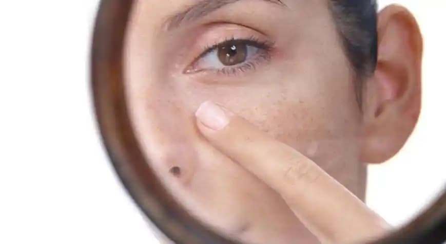 Melazma Nedir, Neden Oluşur ve Kozmetik Çözümler Nelerdir