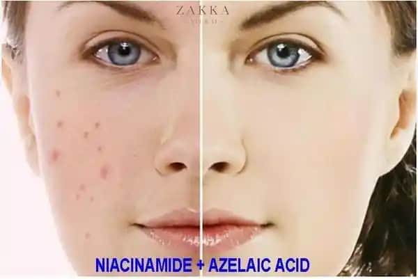 Niacinamide ve Azelaic Asit Birlikteliği: Kullanım Uygunluğu ve Cilt Sağlığı İpuçları