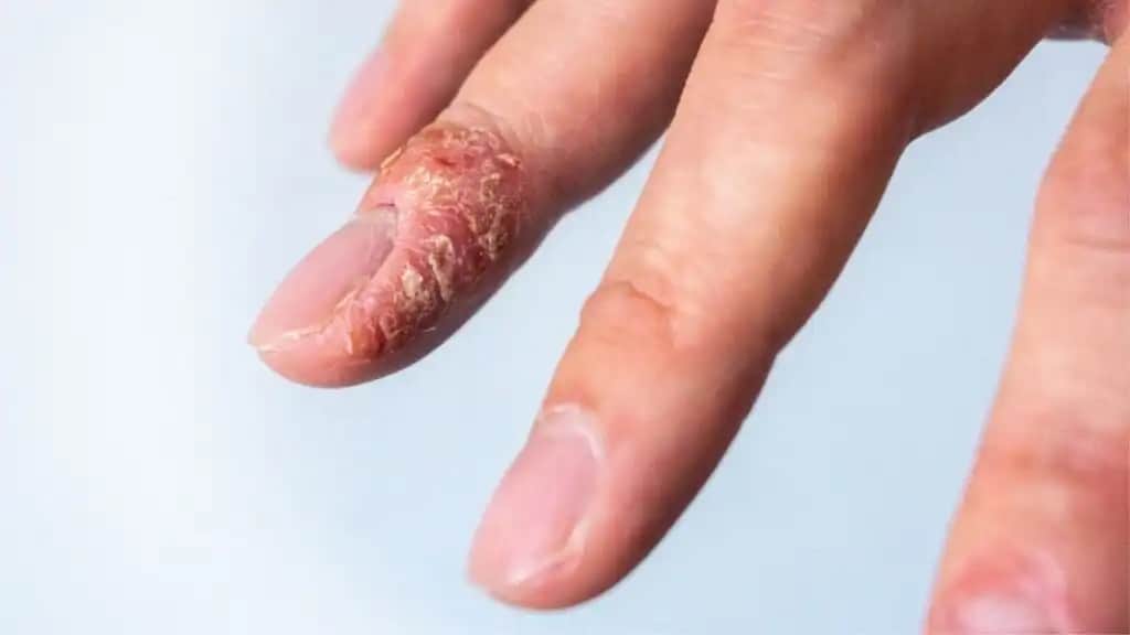 Parmak Arası Egzaması ve Kozmetik Yaklaşımlarla Etkili Yönetimi