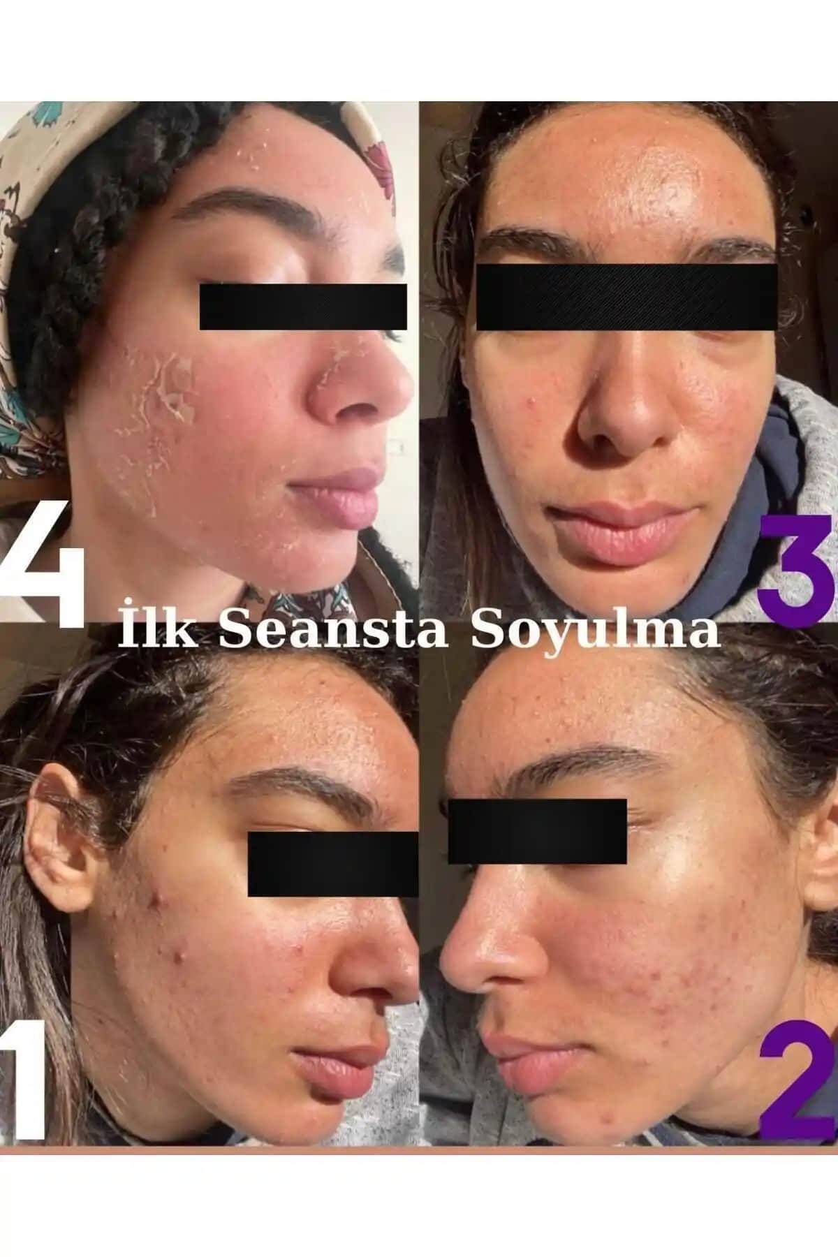 Peeling Cilt Bakımı Hakkında Bilmeniz Gerekenler ve Doğru Uygulama Yöntemleri