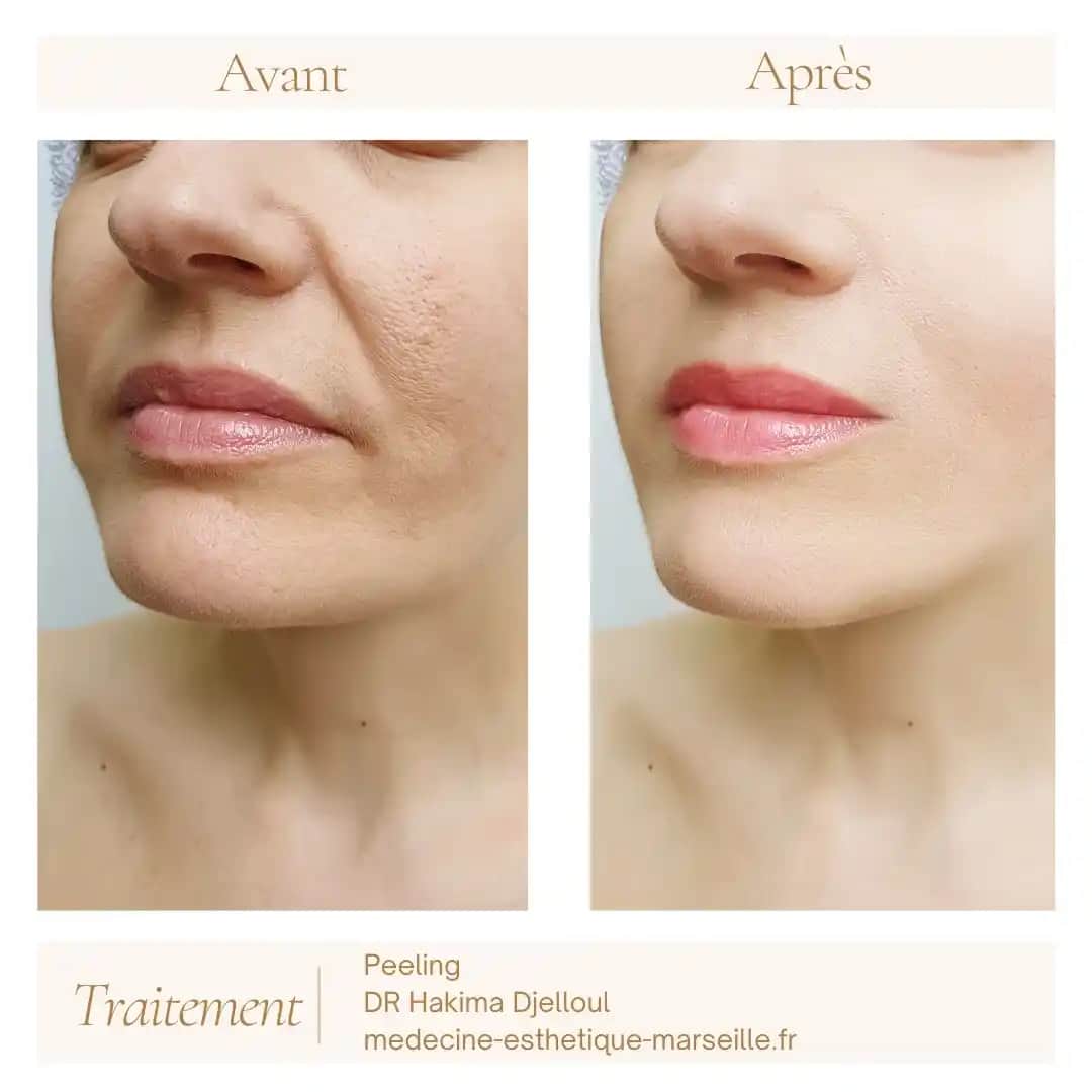 Peeling Visage ile Cilt Yenileme ve Sağlıklı Cilde Giden Yol