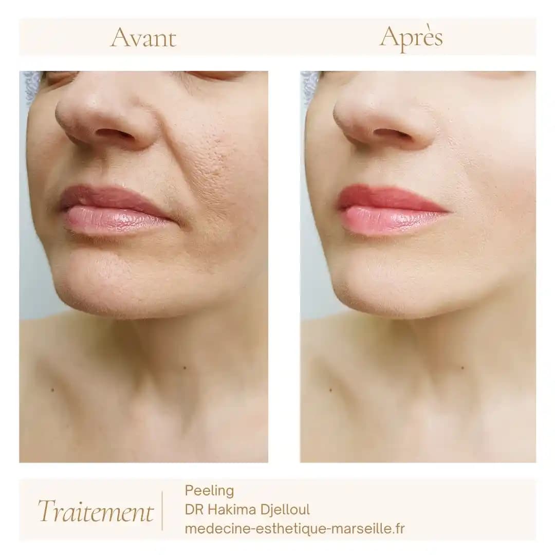 Peeling Visage ile Cilt Yenileme ve Sağlıklı Cilde Giden Yol