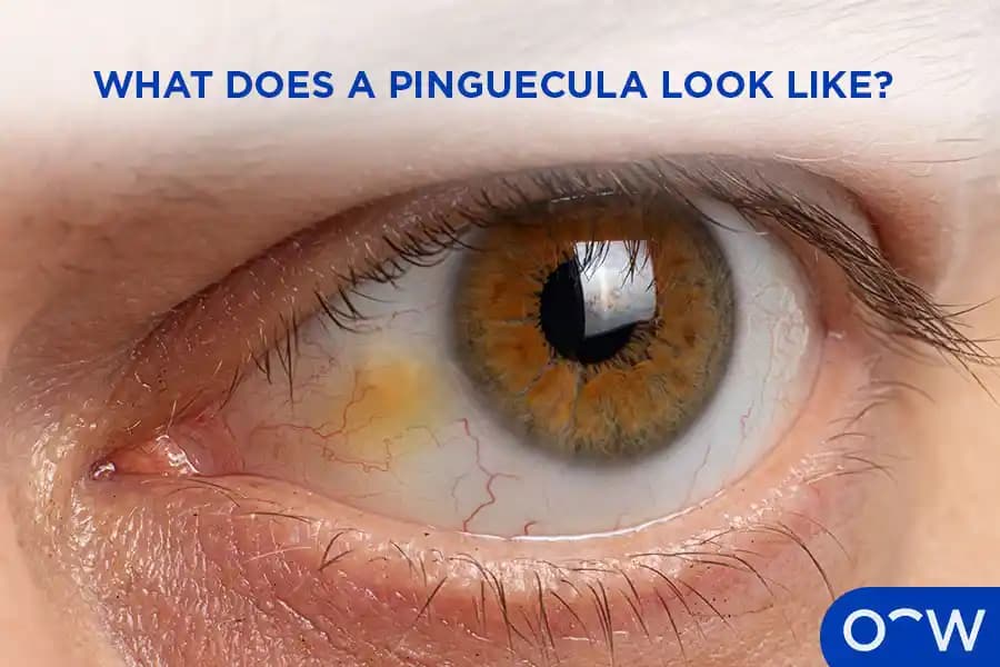 Pingüekula Nedir? Belirtileri, Zararları ve Korunma Yöntemleri Hakkında Bilmeniz Gerekenler