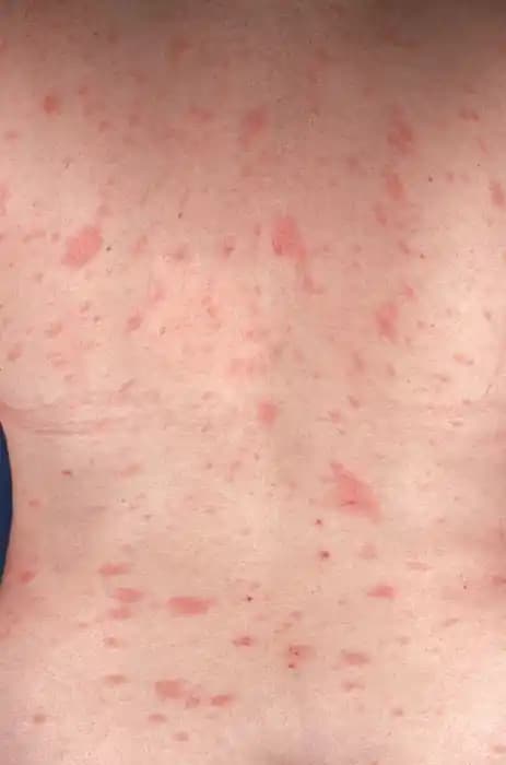 Pityriasis Rosea ve Kozmetik Uygulamalarda Dikkat Edilmesi Gerekenler