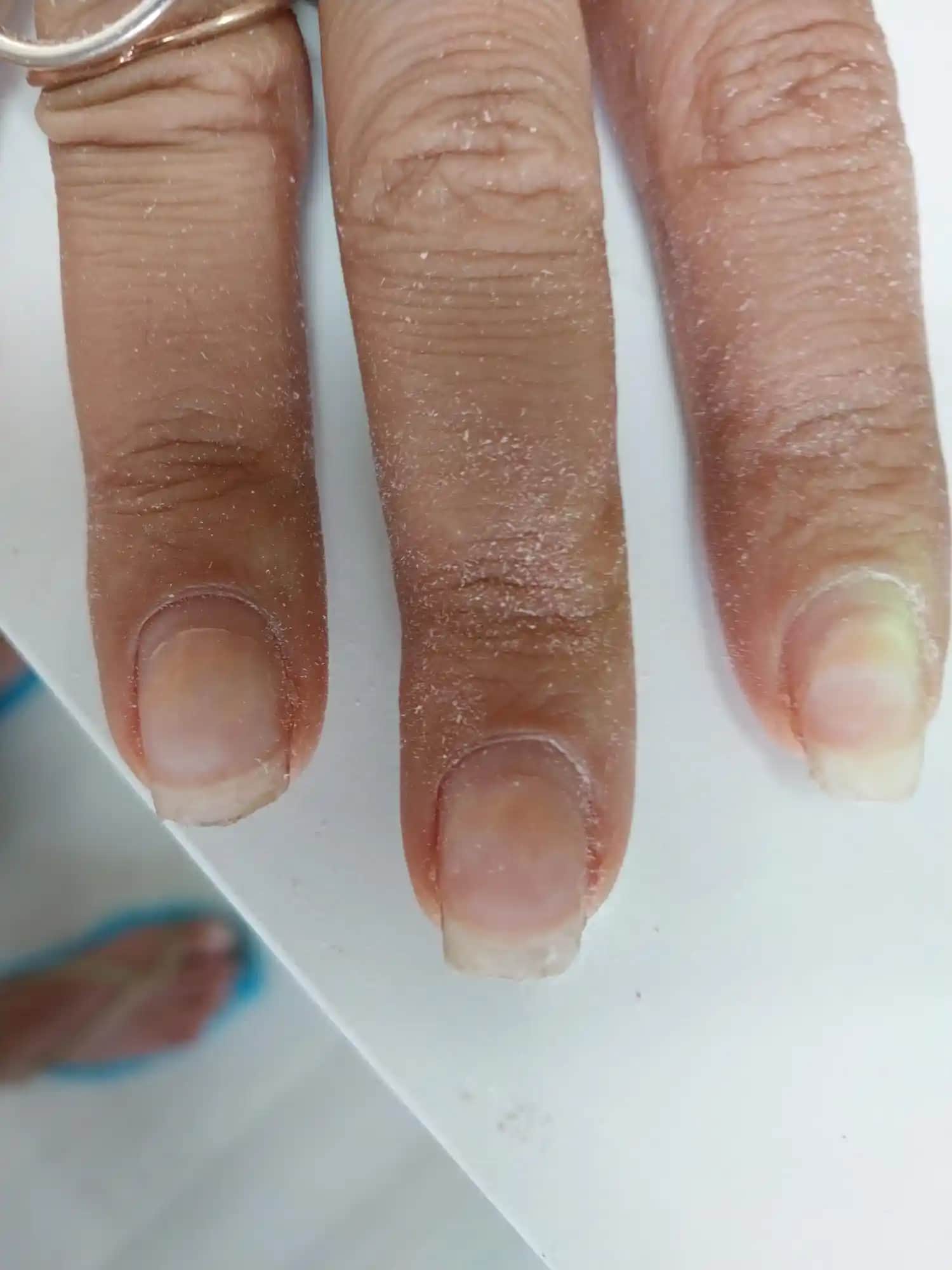 Protez Tırnak ve Mantar Sorunu: Sağlıklı Tırnaklar İçin Bilmeniz Gerekenler