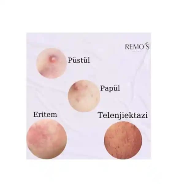 Püsküllü ve Sivilce Sorunlarına Yönelik Güncel Cilt Bakım Yaklaşımları ve Tedavi Seçenekleri