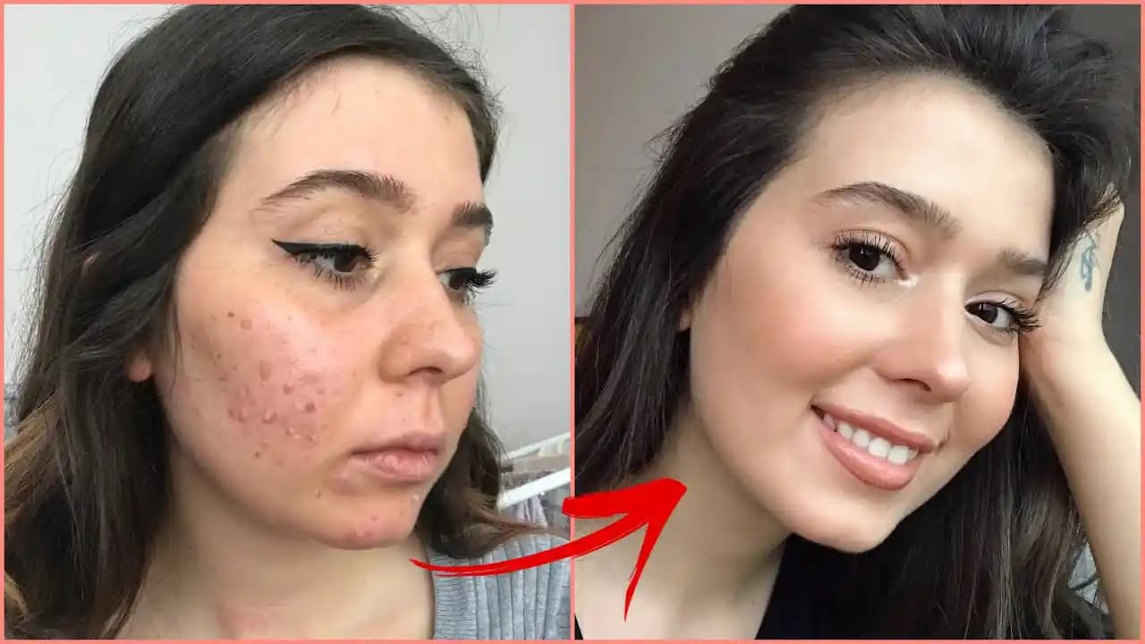 Roaccutane Sonrası Leke Tedavisinde Uygun Kremler ve Cilt Bakım İpuçları