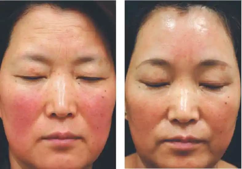 Roza Lazer Tedavisi Nedir ve Kozmetik Sektöründe Nasıl Bir Rol Oynar