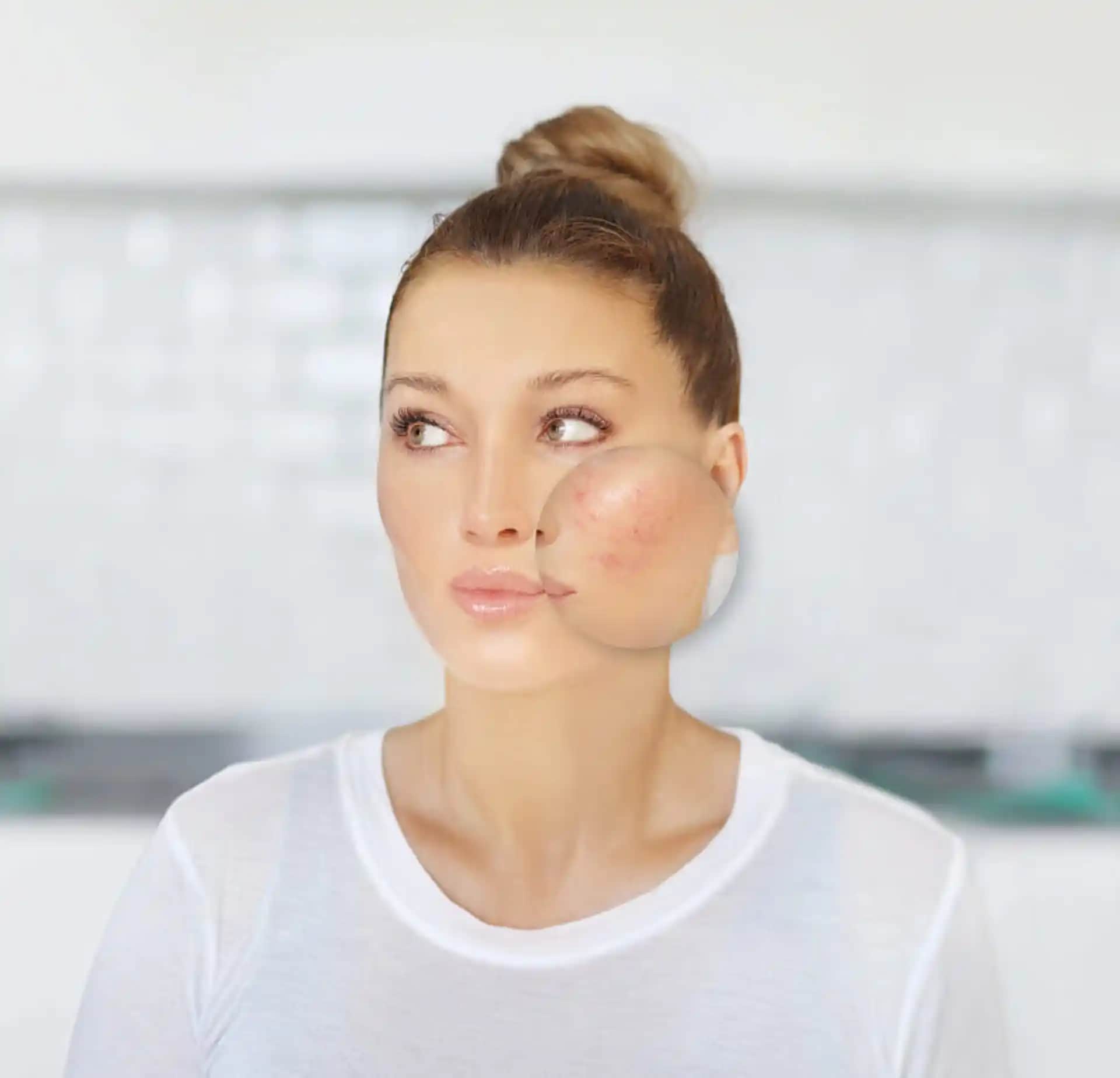 Rozalı Cilt Nedir Belirtileri, Nedenleri ve Etkili Tedavi Yöntemleri